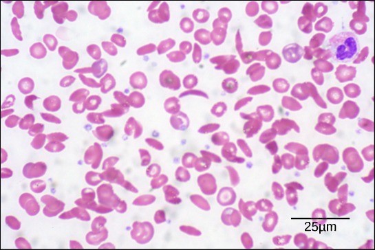 Figure 21.8 In this blood smear, visualized at 535x magnification using bright field microscopy, sickle cells are crescent shaped, while normal cells are disc-shaped.