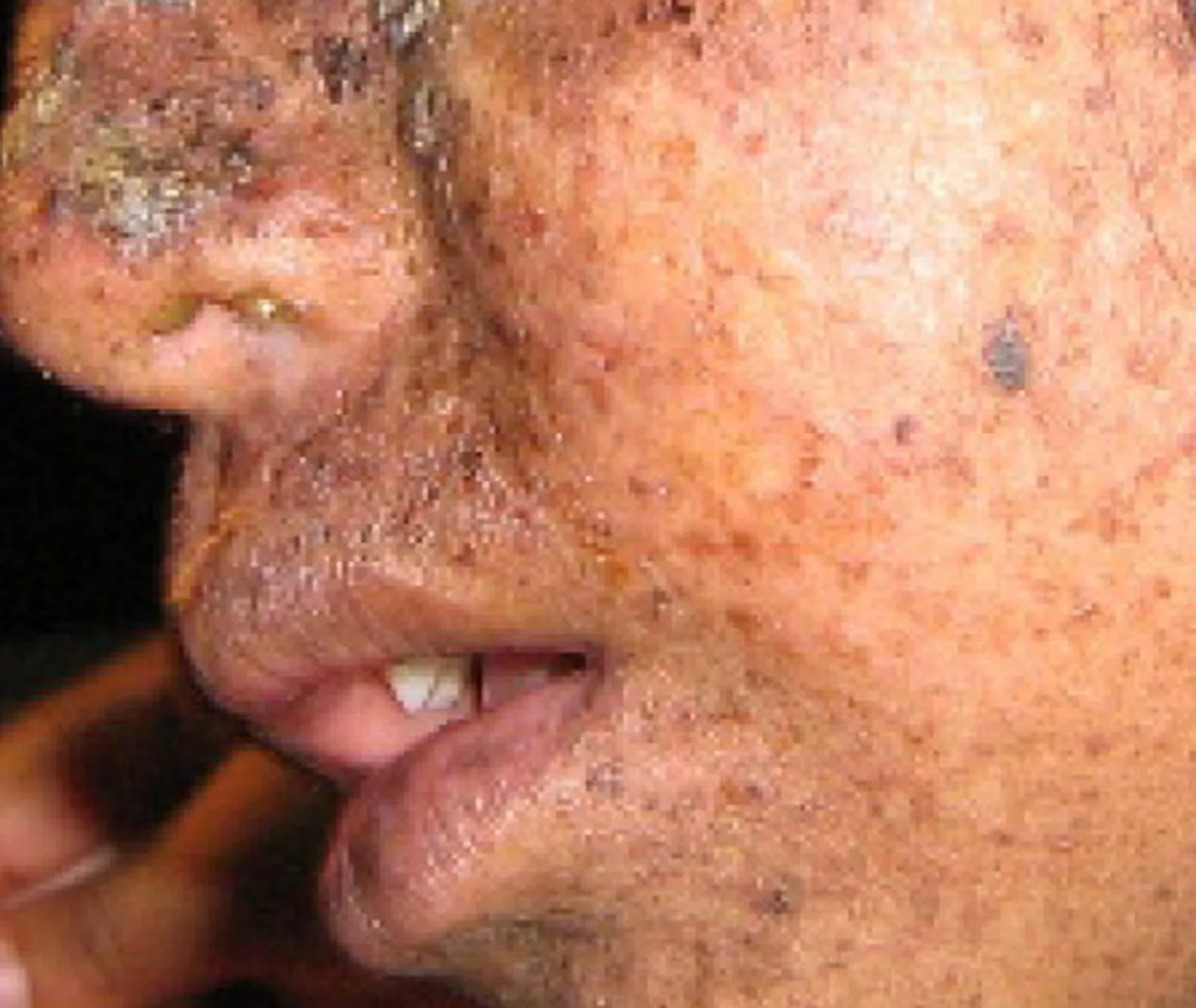 Figure 6.6. Xeroderma pigmentosa is a condition in which thymine dimerization from exposure to UV light is not repaired. Exposure to sunlight results in skin lesions.